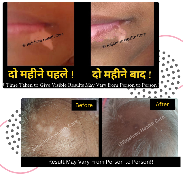 Leucoderma
