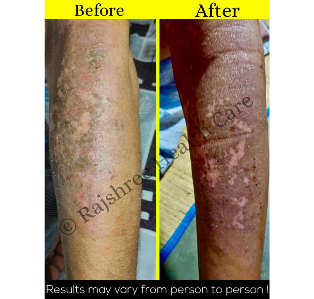 Psoriasis