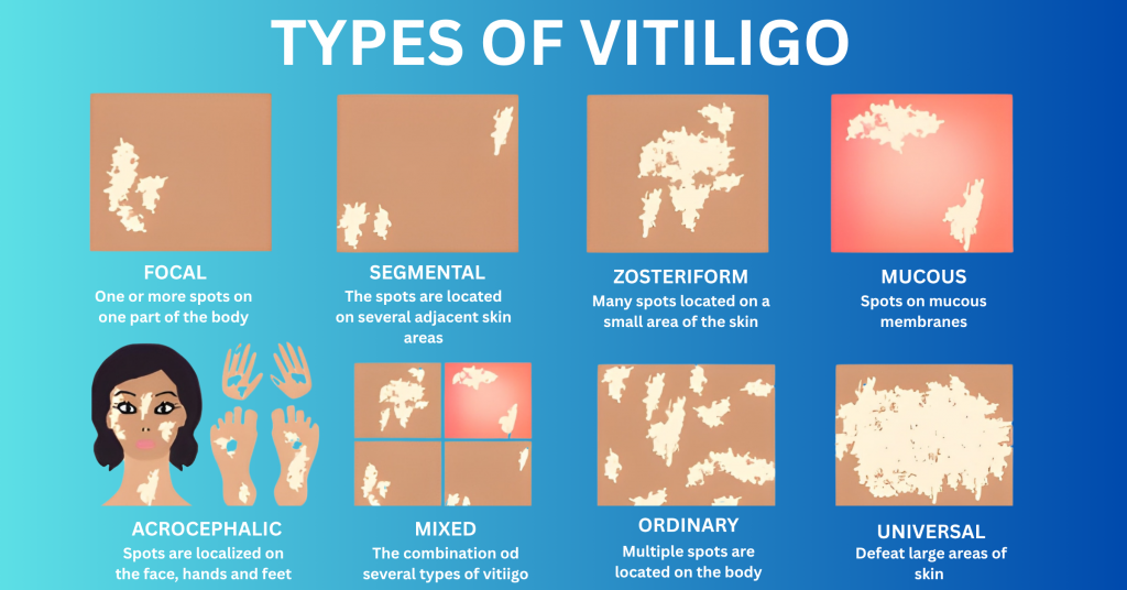 How Many Types of Vitiligo?​