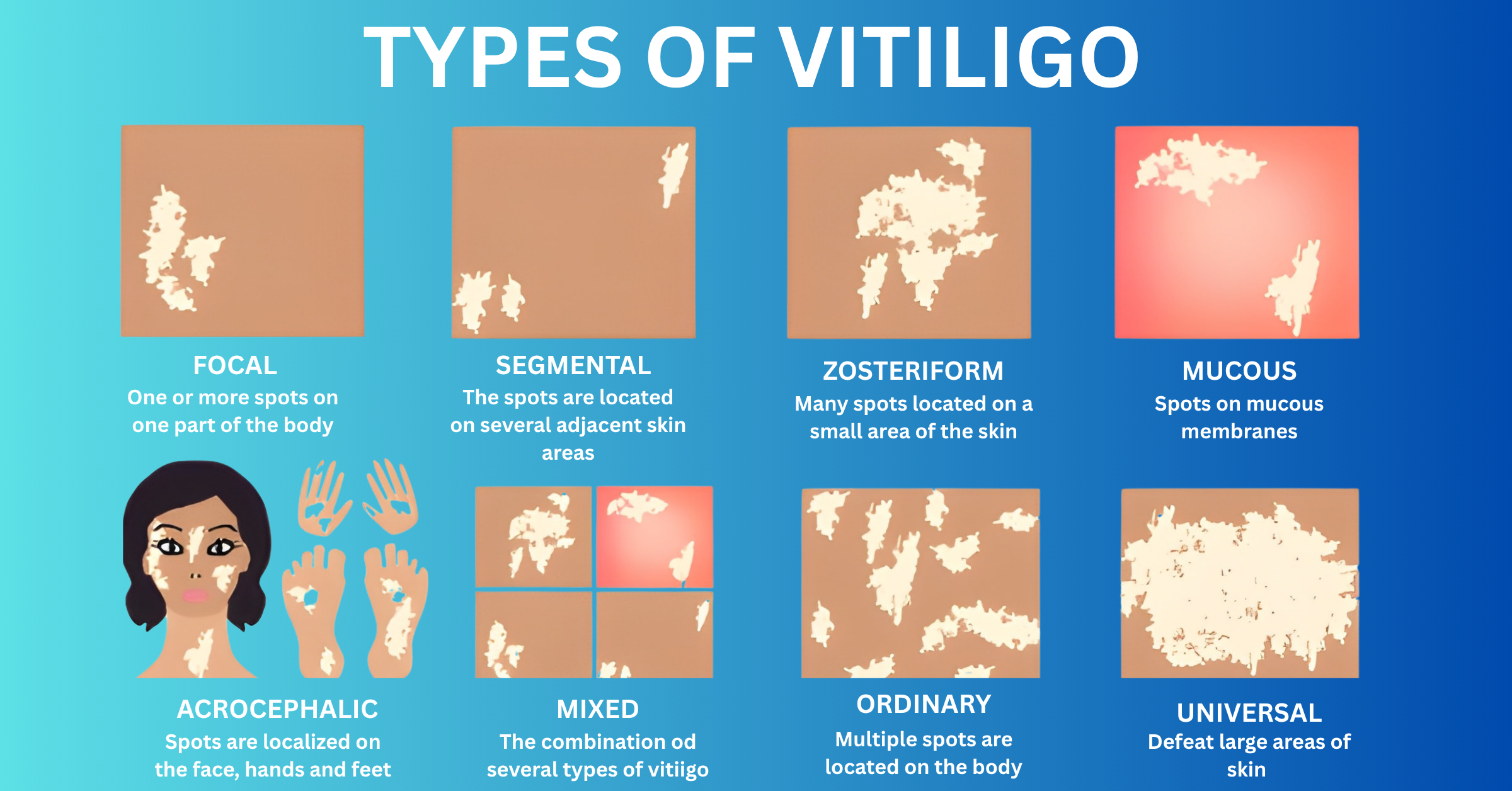 How Many Types of Vitiligo?