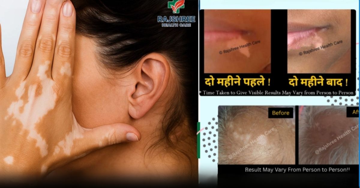 What are the three stages of vitiligo?