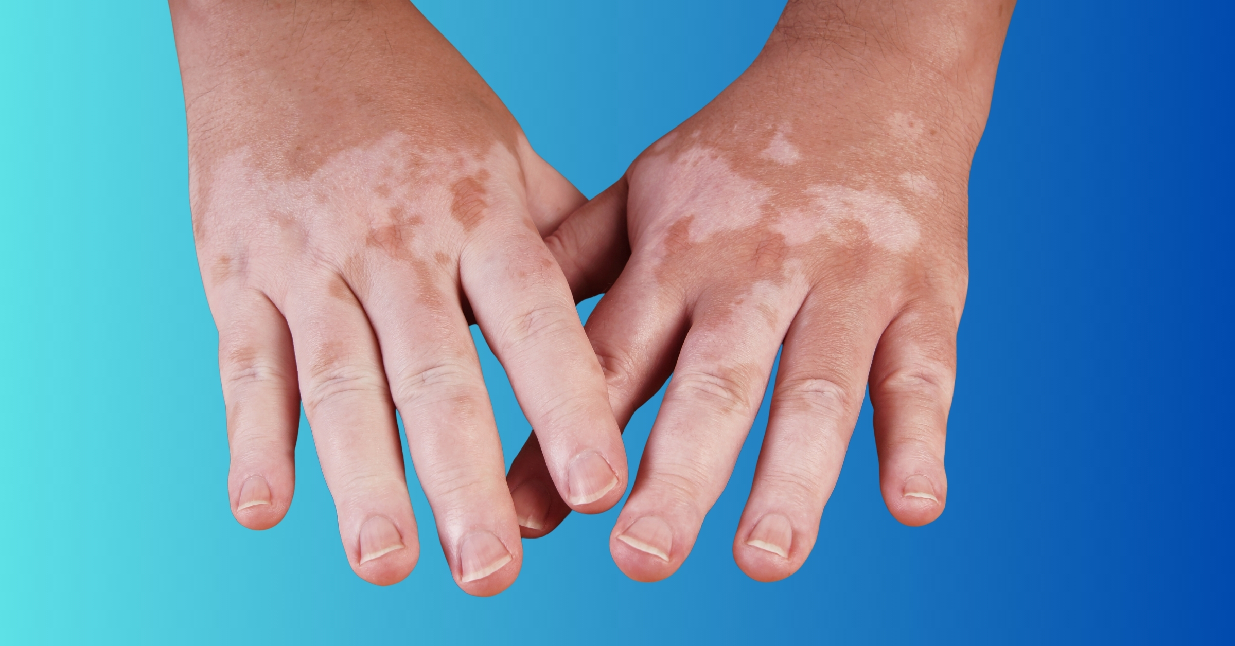 Is Vitiligo a Rare Disease?
